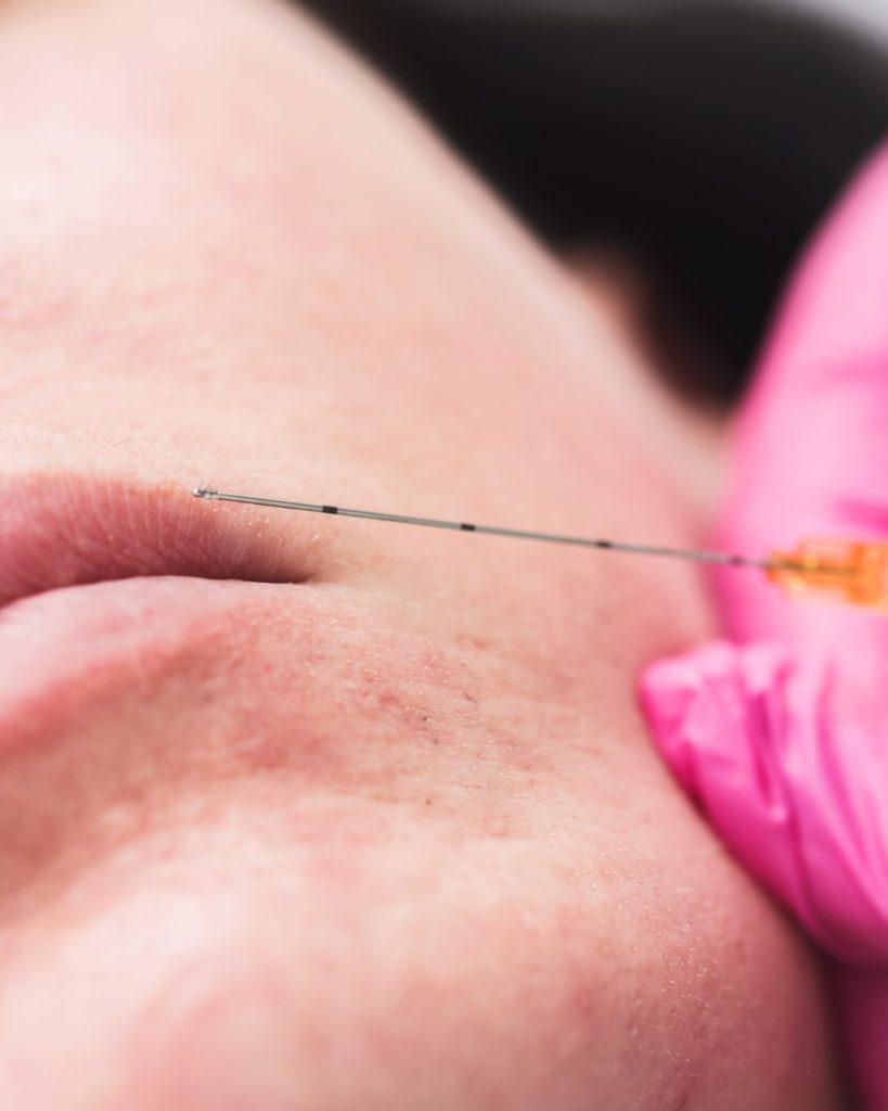 Subcision