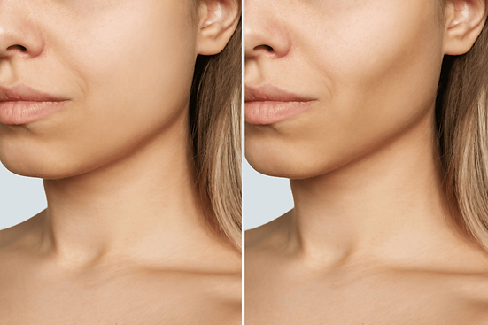 Buccal Fat Removal