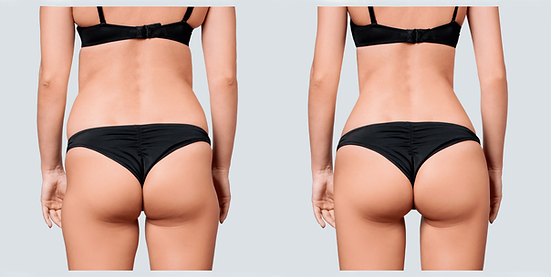 BRAZILIAN BUTTLIFT